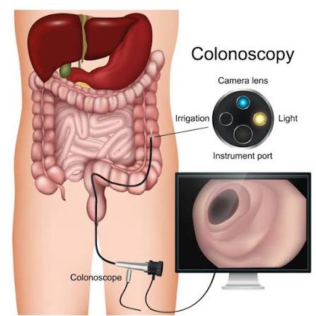 Best Doctor for Colonoscopy in Parel
