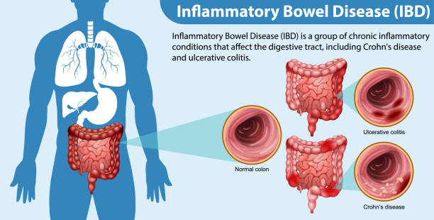 Best Doctor for IBD Treatment in Parel